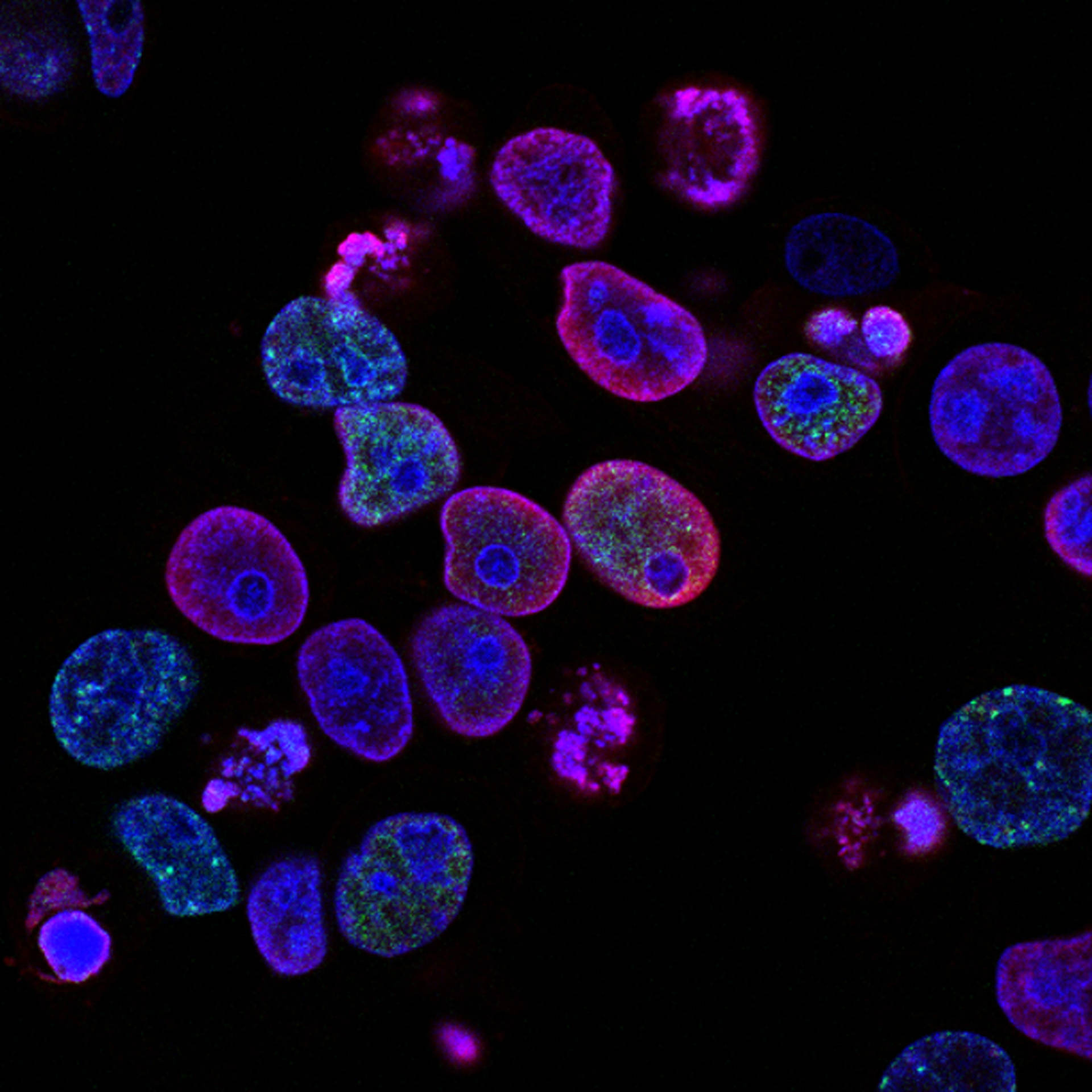 Human colorectal cancer cells treated with a topoisomerase inhibitor and an inhibitor of the protein kinase ATR (ataxia telangiectasia and Rad3 related), a drug combination under study as a cancer therapy. Cell nuclei are stained blue; the chromosomal protein histone gamma-H2AX marks DNA damage in red and foci of DNA replication in green. Created by Yves Pommier, Rozenn Josse, 2014