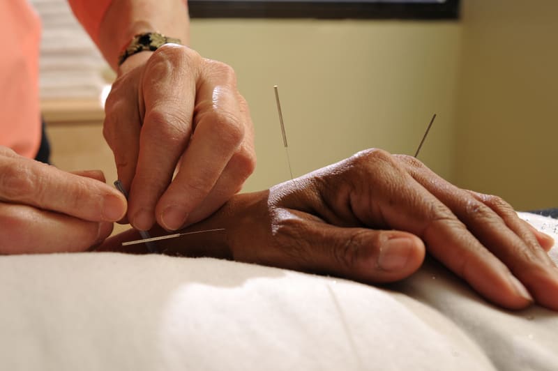 acupuncture treatment